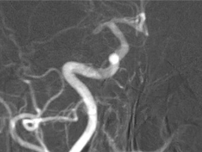 Zobrazení uzávěry cévy v mozku na rentgenovém snímku. Foto: Krajská zdravotní, a.s.