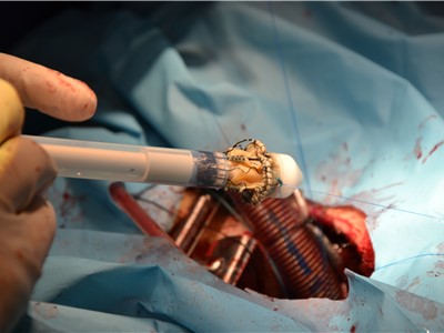 Kardiochirurgové Krajské zdravotní se školili implantovat bezstehovou srdeční chlopeň  