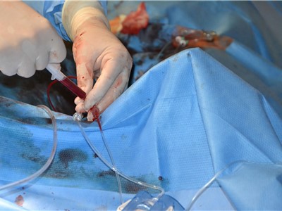 Na katetrizačním sále kardiologické kliniky při perkutánní implantaci chlopně do aortální pozice (TAVI). Foto: Krajská zdravotní, a.s.