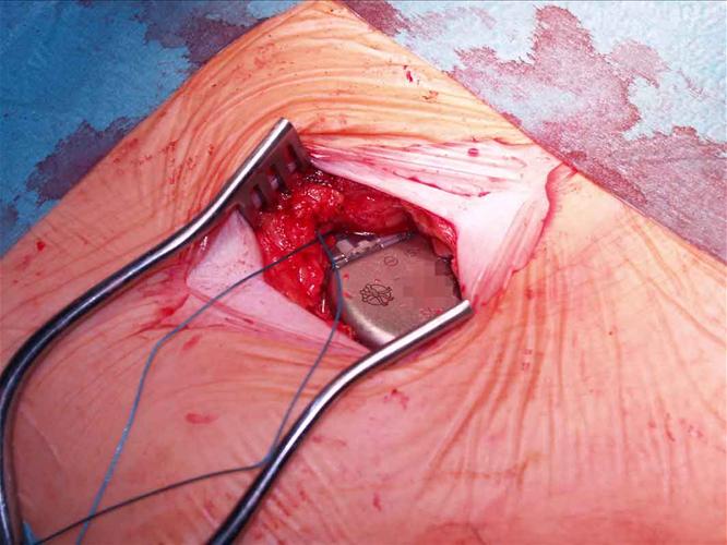 Implantace kardiostimulátoru