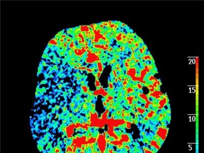 Snížený krevní průtok v pravé mozkové hemisféře při cévní mozkové příhodě. Foto: Krajská zdravotní, a.s. 