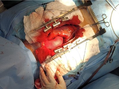 Kardiochirurgové v ústecké Masarykově nemocnici implantovali speciální síťku vyrobenou pacientovi na míru.
